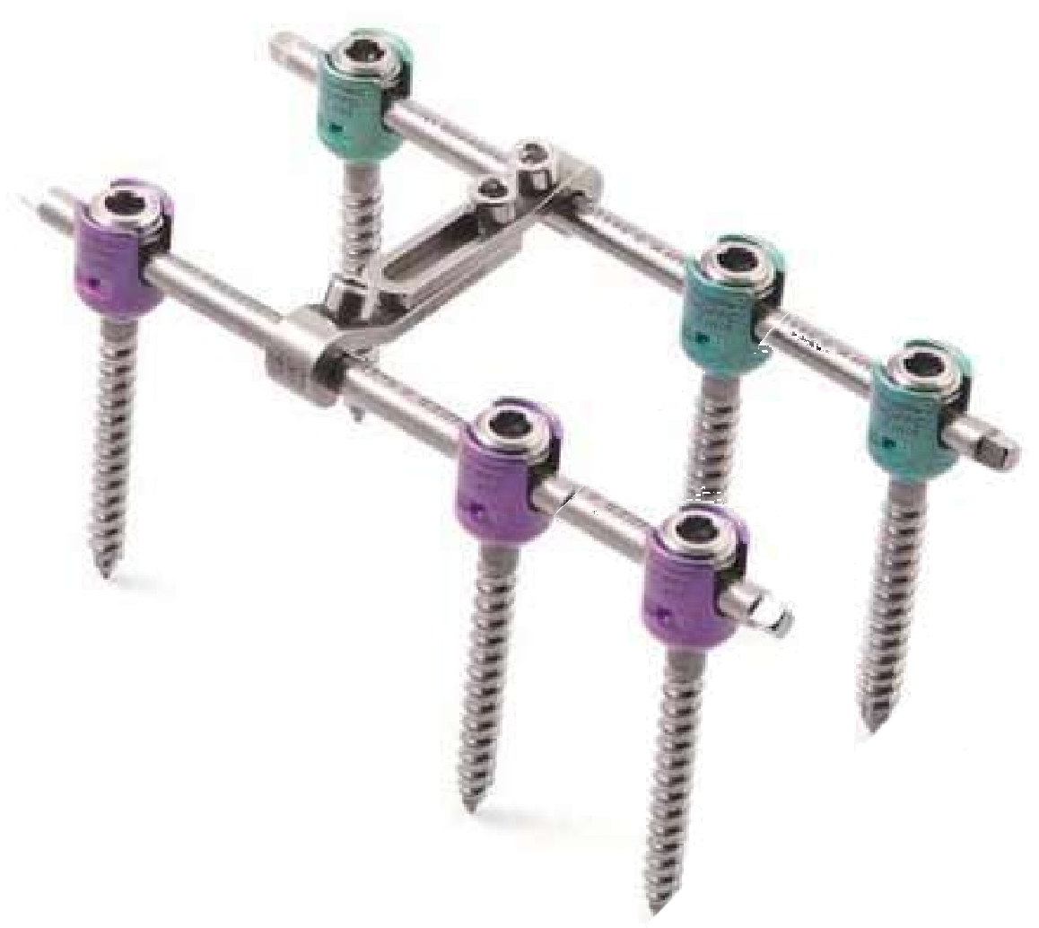 Транспедикулярна конструкція Medical Concept (6 гвинтів)